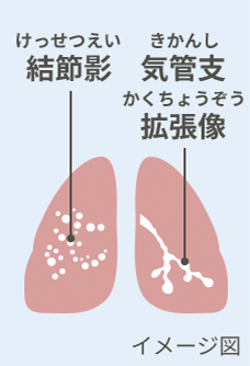 結節影（けっせつえい）と気管支拡張型像（きかんしかくちょうぞう）イメージ図