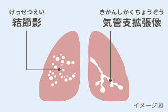 結節影（けっせつえい）と気管支拡張型像（きかんしかくちょうぞう）イメージ図